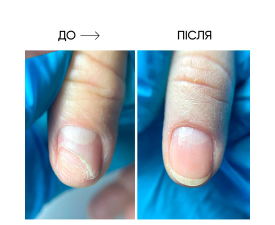 Изображение 6 Масло для ногтей и кожи Onistop Nails Of The Day (для лечения онихолизиса) 15 мл (S-ND), Объем (мл, г): 15