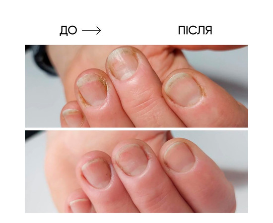 Изображение 5 Масло для ногтей и кожи Onistop Nails Of The Day (для лечения онихолизиса) 15 мл (S-ND), Объем (мл, г): 15