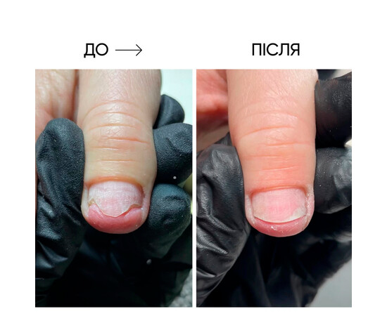 Зображення 4 Олія для нігтів та шкіри Onistop Nails Of The Day (для лікування оніхолізису) 8 мл (S-ND), Об'єм (мл, г): 8