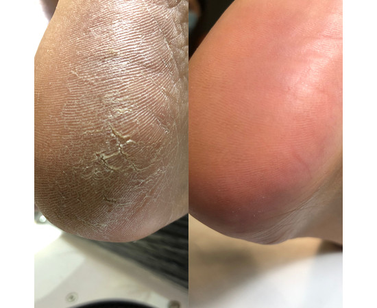 Зображення 4 Крем для стоп із сечовиною Nails Of The Day Podology+ Кератолітик, 100 мл