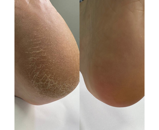 Зображення 5 Крем для стоп із сечовиною Nails Of The Day Podology+ Кератолітик, 100 мл