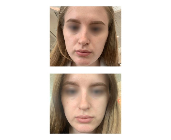 Зображення 5 Набір засобів для карбокситерапії Eco.prof.cosmetics Blue Carboxy Therapy, 3х50 мл