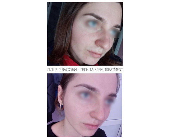 Зображення 2 Гель для обличчя очищуючий кислотний Eco.prof.cosmetics Treatment Cleanser, 100 мл