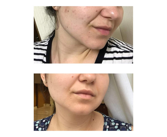 Зображення 3 Маска для шкіри з акне з бензоїл пероксидом Eco.prof.cosmetics Treatment Mask, 50 мл