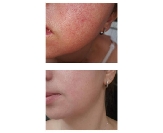 Изображение 2 Маска для лица с пробиотиками (3 шаг карбокситерапии) Eco.prof.cosmetics Immuno Mask, 50 мл 