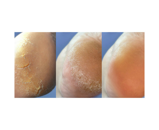 Зображення 2 Крем від тріщин на шкірі рук та стоп Nails of the Day Podology+, 30 мл