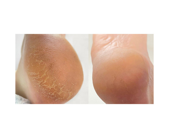 Зображення 3 Крем від тріщин на шкірі рук та стоп Nails of the Day Podology+, 30 мл