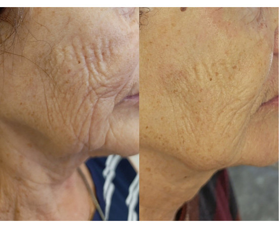 Зображення 6 Сироватка для обличчя Kaetana "Пента-Гексапептид", стимулює синтез колагену, розгладжує зморшки, 10 мл, Аромат: Натуральный, Об'єм (мл, г): 10