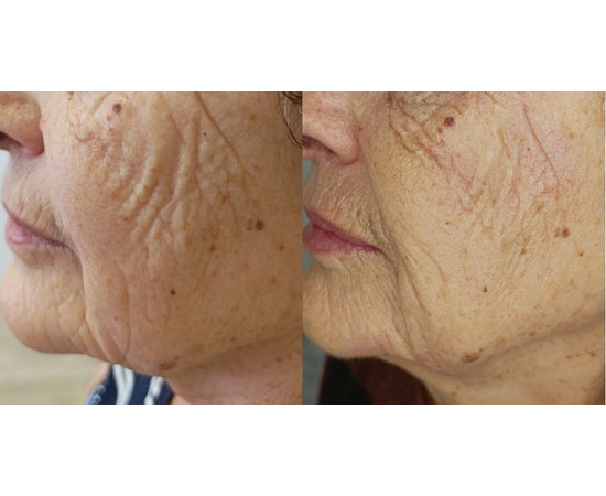 Зображення 2 Сироватка для обличчя Kaetana "Пента-Гексапептид", стимулює синтез колагену, розгладжує зморшки, 5 ампул (упаковка) по 10 мл, Аромат: Натуральный, Об'єм (мл, г): 50